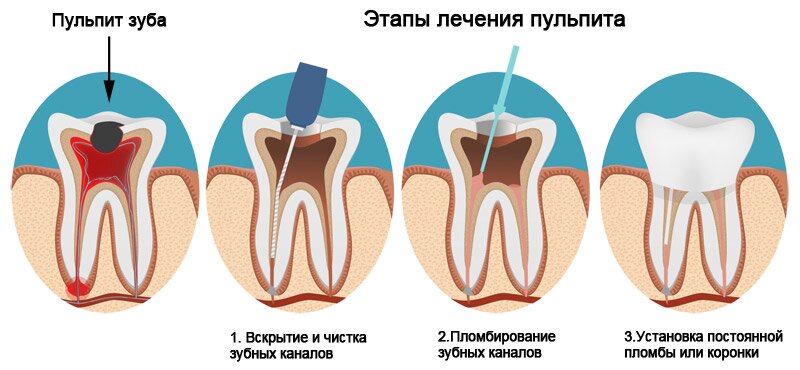 Лечение пульпита зуба у взрослых