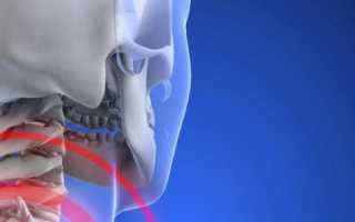 Причины, симптомы и лечение остеохондроза шейного отдела позвоночника