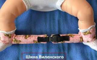 Как лечить вывих тазобедренного сустава у новорожденных