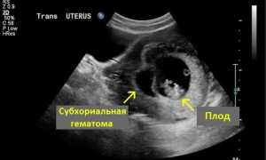 Беременность на раннем сроке и гематома. Есть ли шансы?