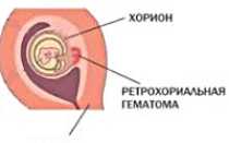 Гематома при беременности