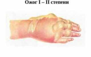Что делать если появились волдыри после ожога