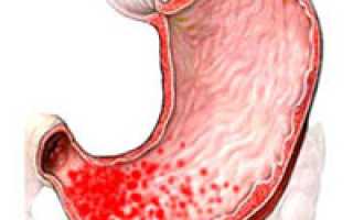 Признаки и лечение повышенной кислотности желудка