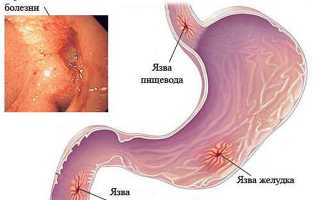 Что такое пептическая язва желудка?