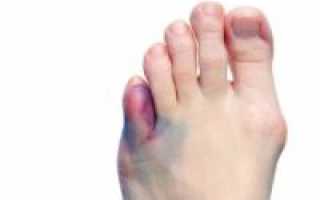 Травмы пальца на ноге: как лечить