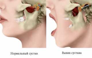 Подвывих челюсти – как распознать и чем лечить?