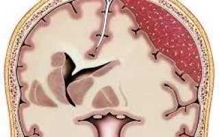 Симптомы и лечение гематомы головного мозга