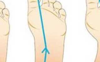 Главный враг всех ног. Как распознать поперечное плоскостопие и бороться с ним