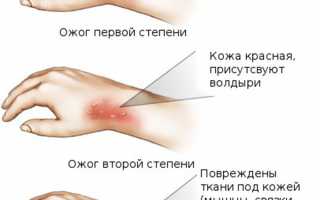 Что делать после ожога и какое средство лучше помогает в лечении?