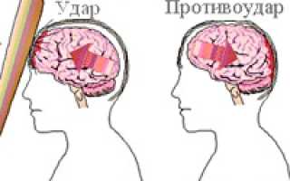 Ушиб головного мозга